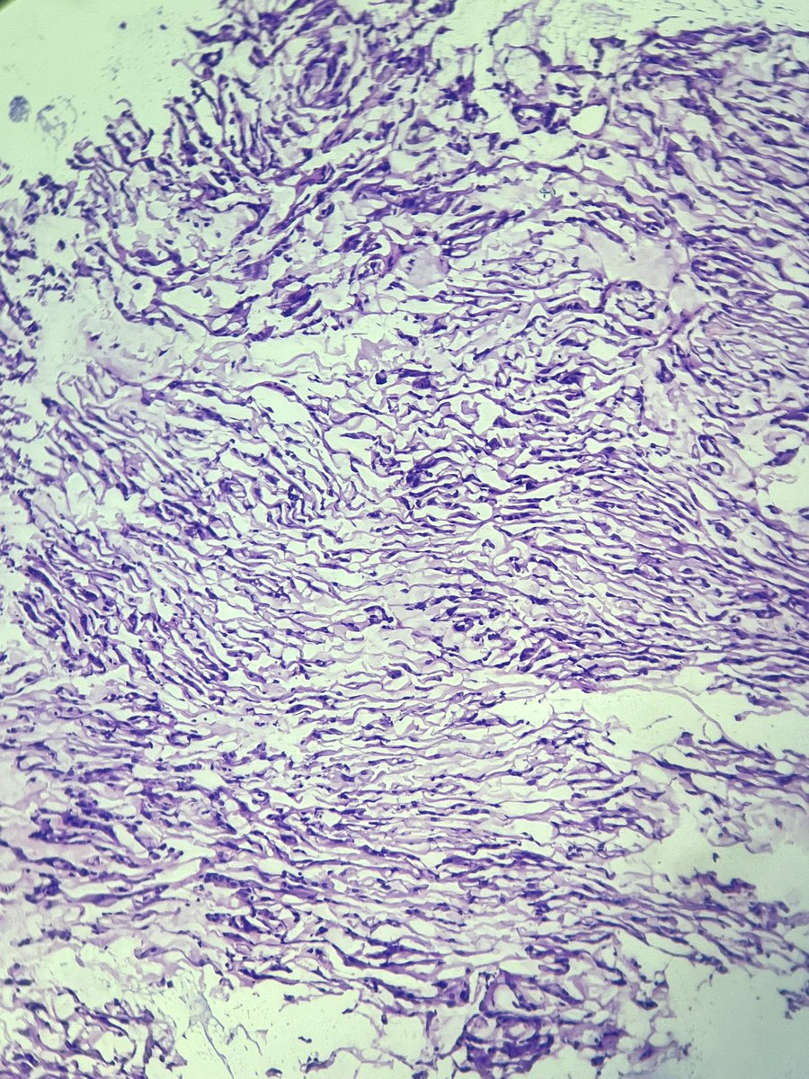 Immanuel_Paul30's tweet image. The corresponding frozen section ! Any guess on the subtype 🪸🪢 🏳️‍⚧️ !