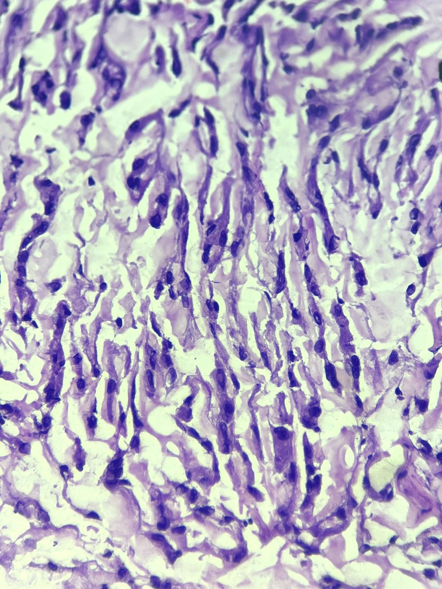 Immanuel_Paul30's tweet image. The corresponding frozen section ! Any guess on the subtype 🪸🪢 🏳️‍⚧️ !