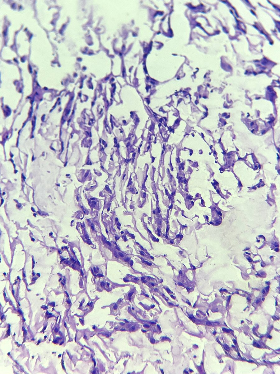 Immanuel_Paul30's tweet image. The corresponding frozen section ! Any guess on the subtype 🪸🪢 🏳️‍⚧️ !