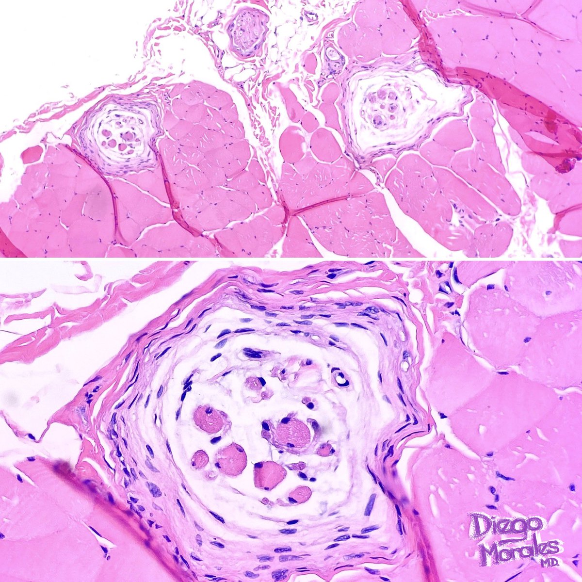 Hi #PathTwitter when you find within skeletal muscle 🥩 something that reminisces a peripheral nerve with a few muscle fibers snuck in: Congrats, you found a muscle spindle, a stretch propioceptor. 

 #JoyForMorfology #histobeauty #pathology #patologia