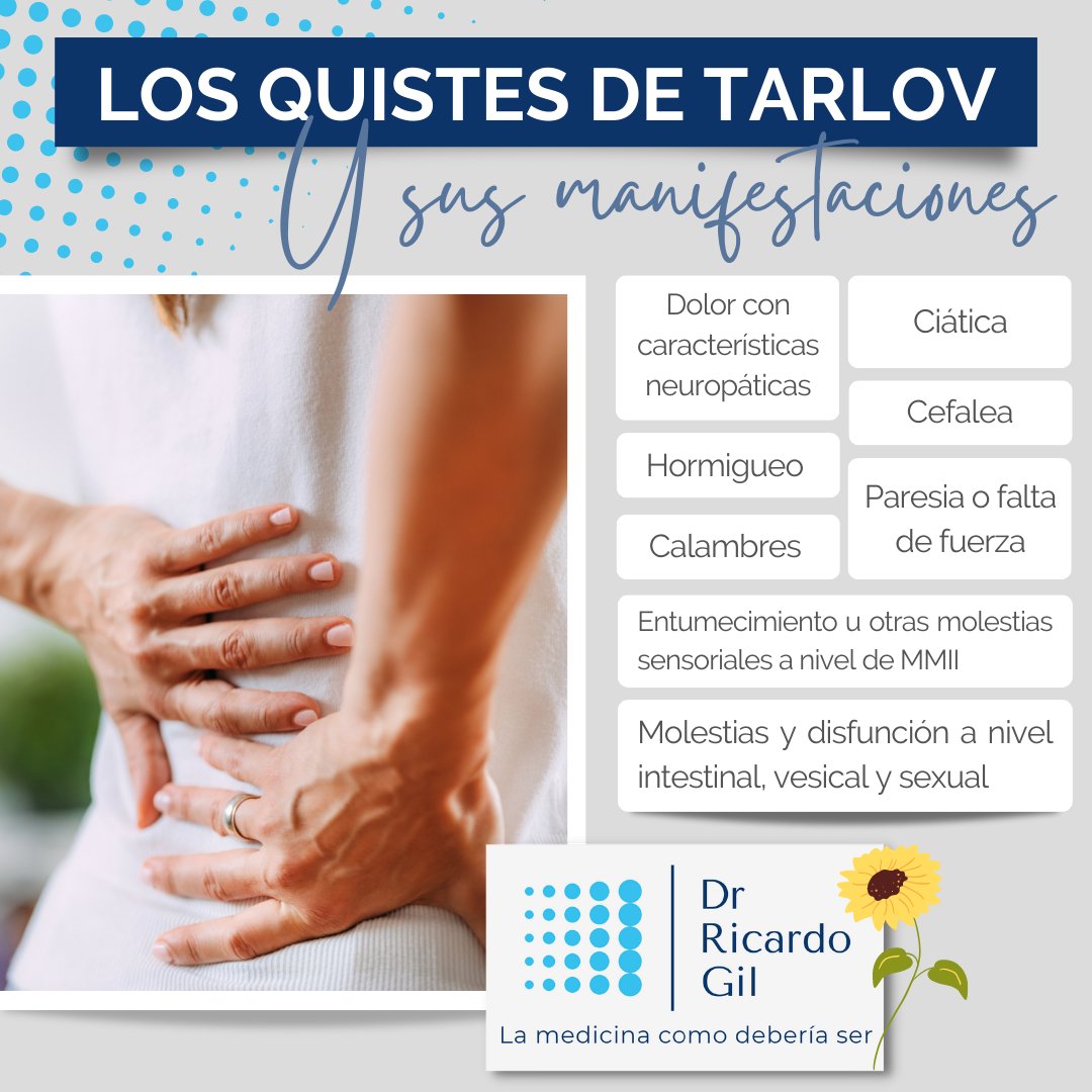 🔎 Aunque el propio quiste de #Tarlov sea asintómatico y muchas veces un hallazgo incidental en el estudio de otras patologías, esto no significa que no esté infradiagnosticado ni que los pacientes sintomáticos no sufran de un #dolor que puede llegar a ser incapacitante ⬇️⬇️⬇️
