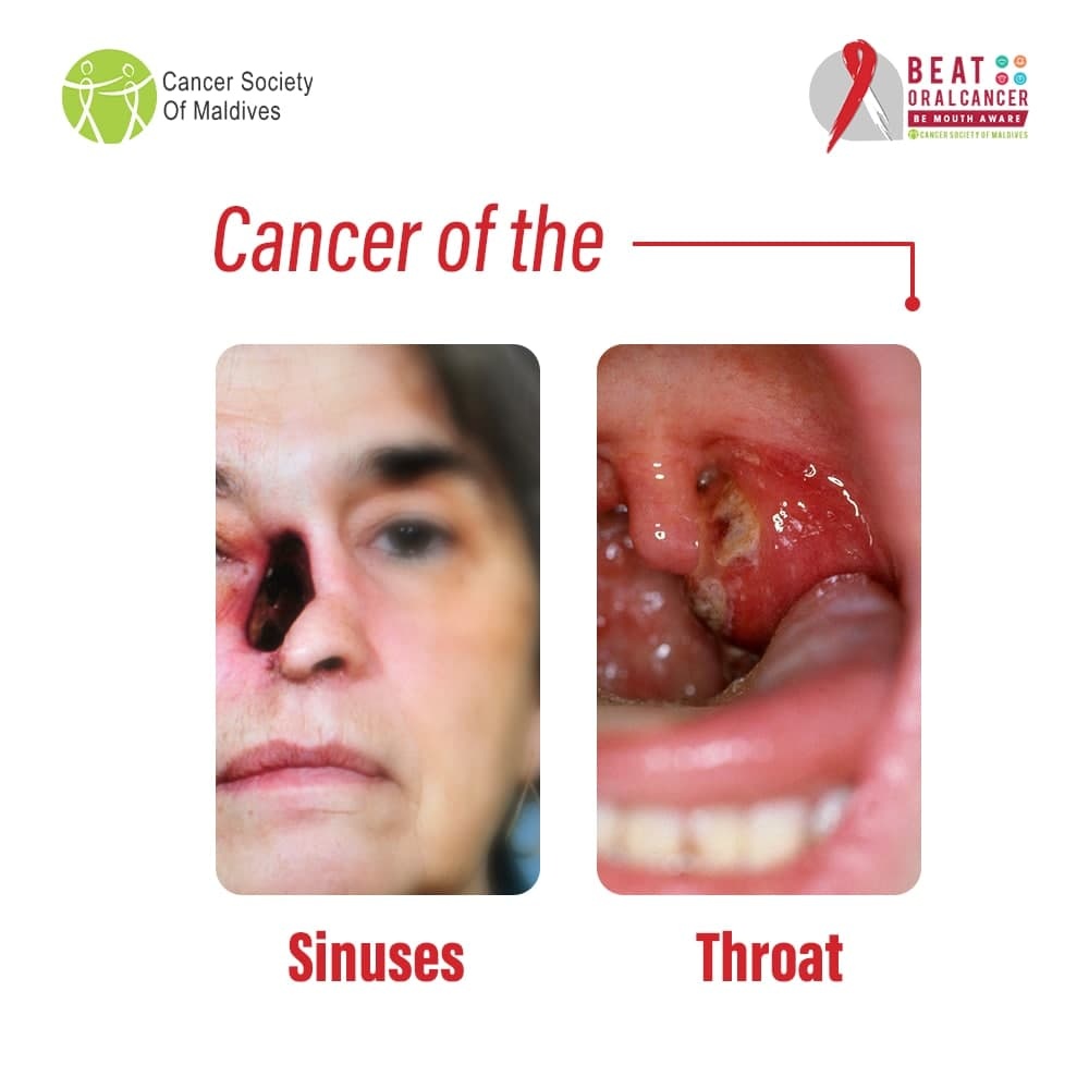 CancerSocietyMV's tweet photo. Oral cancer can develop in most parts of the mouth, including the lips, sinuses, throat, tongue and floor of the mouth.

#BeatOralCancer https://t.co/qSVgVktpxW