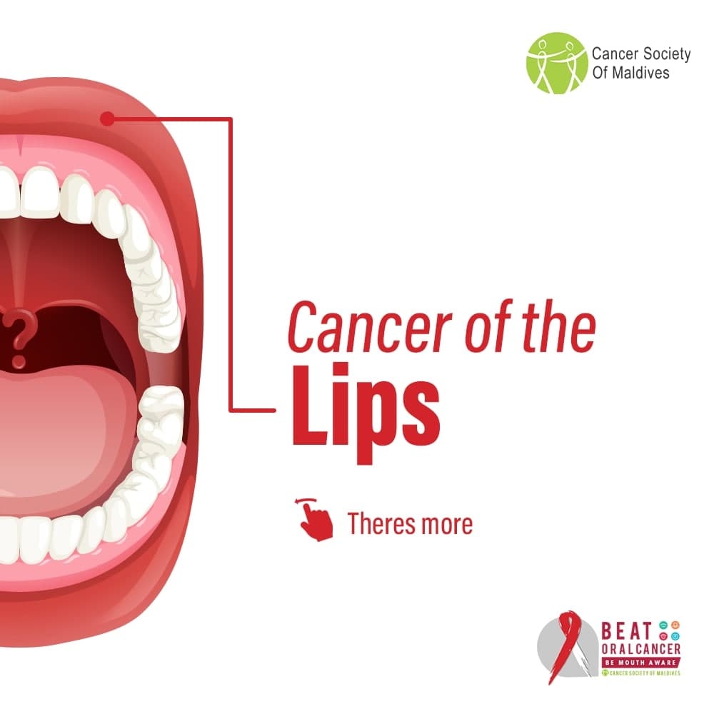 CancerSocietyMV's tweet photo. Oral cancer can develop in most parts of the mouth, including the lips, sinuses, throat, tongue and floor of the mouth.

#BeatOralCancer https://t.co/qSVgVktpxW
