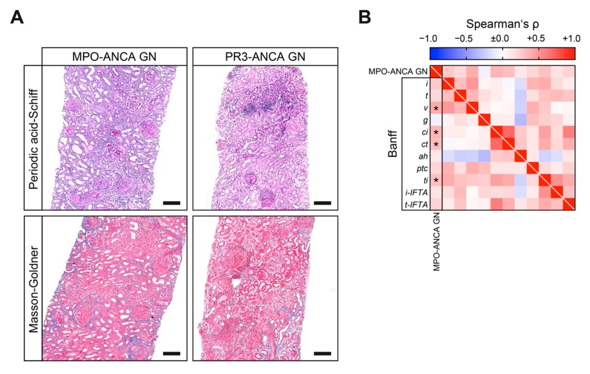 JCM_MDPI's tweet image. #mdpijcm 
😍Systematic Histological Scoring Reveals More Prominent #Interstitial Inflammation in Myeloperoxidase-ANCA Compared to Proteinase 3-ANCA #Glomerulonephritis 

👥Authors: Björn Tampe et al.  @uniGoettingen

More at: mdpi.com/2077-0383/10/6…