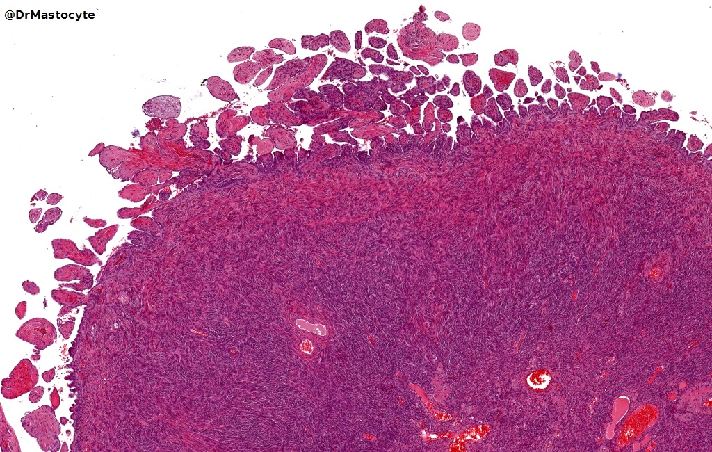 Ovarian surface stromal proliferation #GYNpath #Pathology