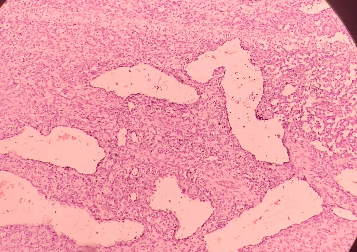 DrVeerashetty's tweet image. 6m old female with liver lesion, case of Infantile hemangioendothelioma, IHC Cd31 and CD34
