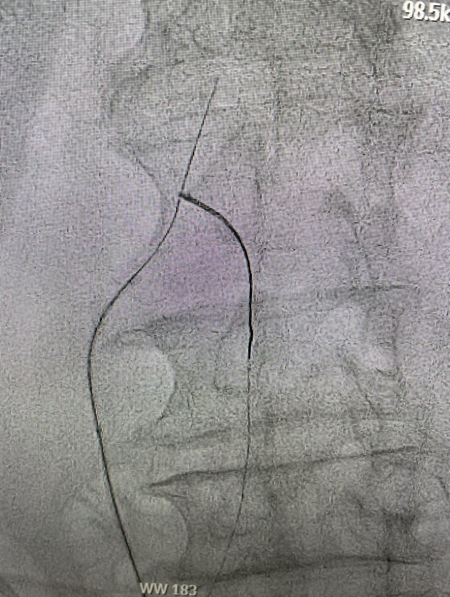 Tahmad_dogar's tweet image. Elderly with LIMA supplying LAD/RCA collateral and iFR positive LMCA to LCX/RI disease not pretty for PCI, occluded L ICA and intervened twice RICA and severe iliofemoral PAD @DrTylerWallen @b_kuscavage @Luvlev231 @najamsaqibMD
