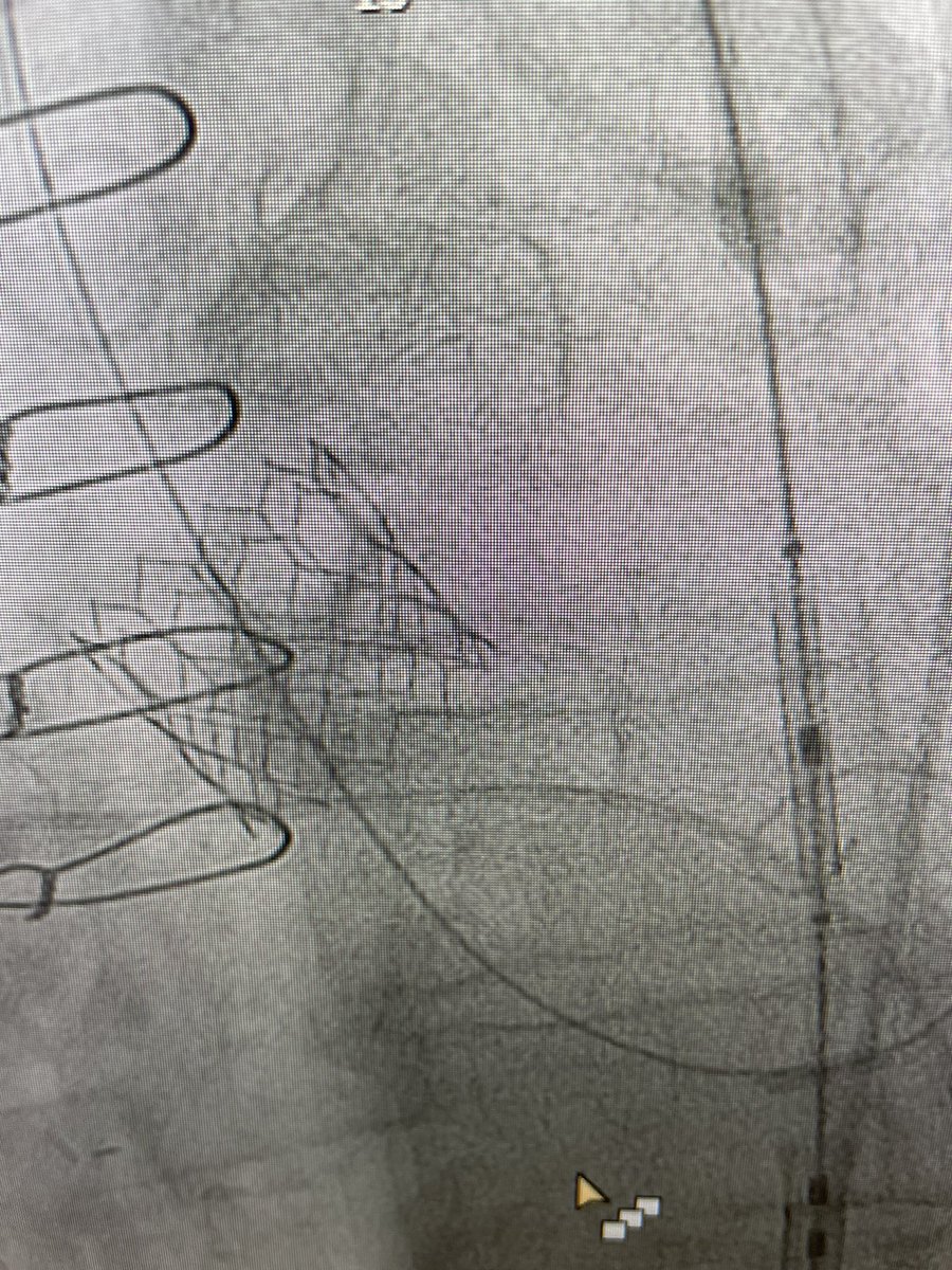 Tahmad_dogar's tweet image. Elderly with LIMA supplying LAD/RCA collateral and iFR positive LMCA to LCX/RI disease not pretty for PCI, occluded L ICA and intervened twice RICA and severe iliofemoral PAD @DrTylerWallen @b_kuscavage @Luvlev231 @najamsaqibMD