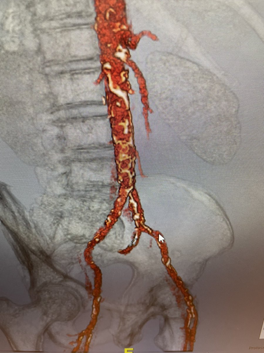 Tahmad_dogar's tweet image. Elderly with LIMA supplying LAD/RCA collateral and iFR positive LMCA to LCX/RI disease not pretty for PCI, occluded L ICA and intervened twice RICA and severe iliofemoral PAD @DrTylerWallen @b_kuscavage @Luvlev231 @najamsaqibMD