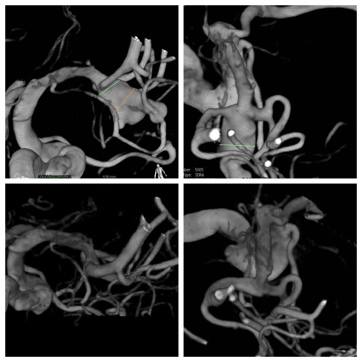 #contour 1 year folllow up!! <a href="/IncCerus/">Cerus Endovascular</a> <a href="/Stryker_NV/">StrykerNeurovascular</a> let’s keep enrolling!!!