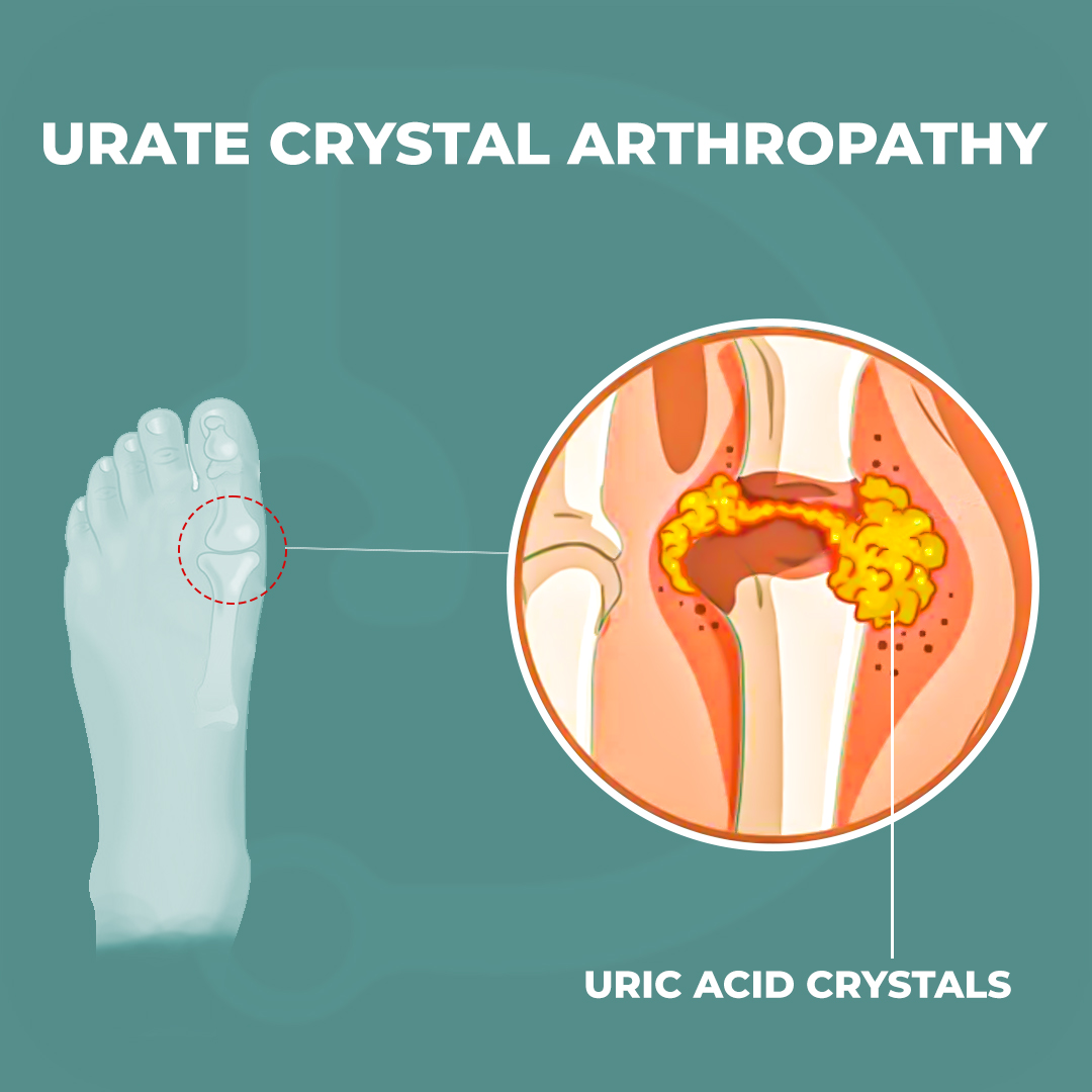 Docsteth1's tweet photo. Urate crystal arthropathy is a type of arthritis that affects many people worldwide.
To know more about Urate Crystal Arthropathy click on the link
🔗https://t.co/z4TzWfggZ5
#Gout #Hyperuricaemia #UrateCrystals #chronicpain #chronicillness #pain #jointpain #fibromyalgia #Docsteth https://t.co/vjMvcQiipY