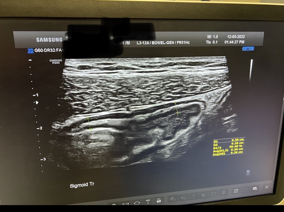 sharonAPevsner's tweet image. Bowel ultrasound Dec 2022 vs April 3, 2023. Started CurQD Jan 31, 23. Amazing results for my son&apos;s UC! @Evinature_ @NirSalomon3 @ShomronH @CrohnsColitisFn @ChildrensLA