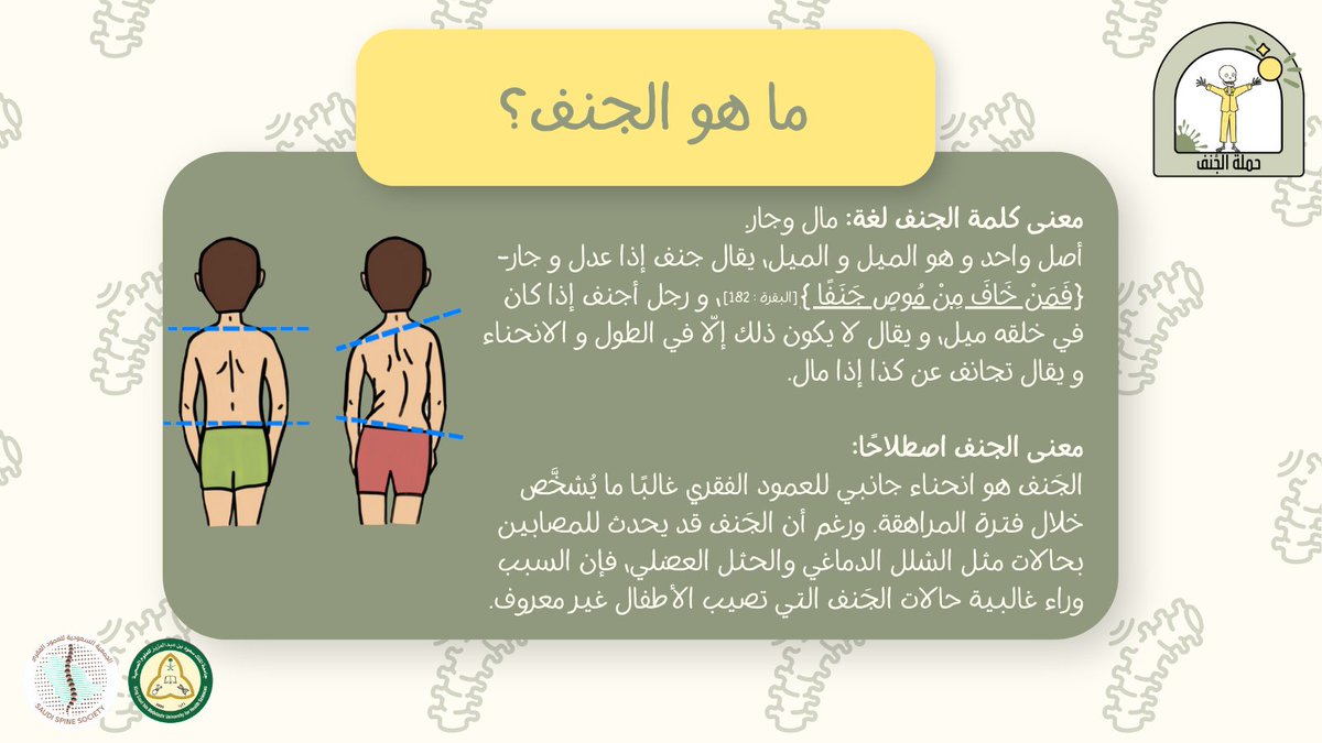 SaudiSpine's tweet photo. تعريف مرض الجنف🩻 :
#حملة_الجنف⁩
 ⁧#كاساو⁩ 
⁦@KSAU_HS⁩ ⁦@COMKSAU⁩ ⁦@SaudiSpine⁩ https://t.co/CoxvjRjwmH