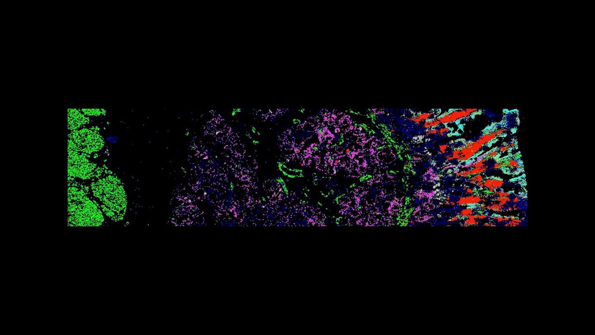 NIH_CommonFund's tweet photo. Dr. Chenchen Zhu @Snyder_Lab_SU @stanfordmed uses #MolecularCartography to find different types of RNA within polyps from Familial adenomatous polyposis (FAP) patients, hoping to find ways to treat &amp; diagnosis #colorectalcancer more quickly.  #_hubmap, #CellMapCrew https://t.co/ze7ZwHGNPw