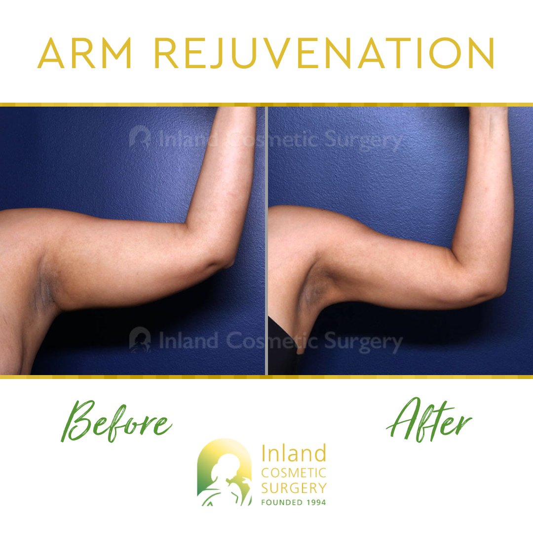 Happy #TransformationTuesday! 🤩💪 

This patient in her 30s is shown 1-year post-op from upper #ArmLiposuction with Renuvion.