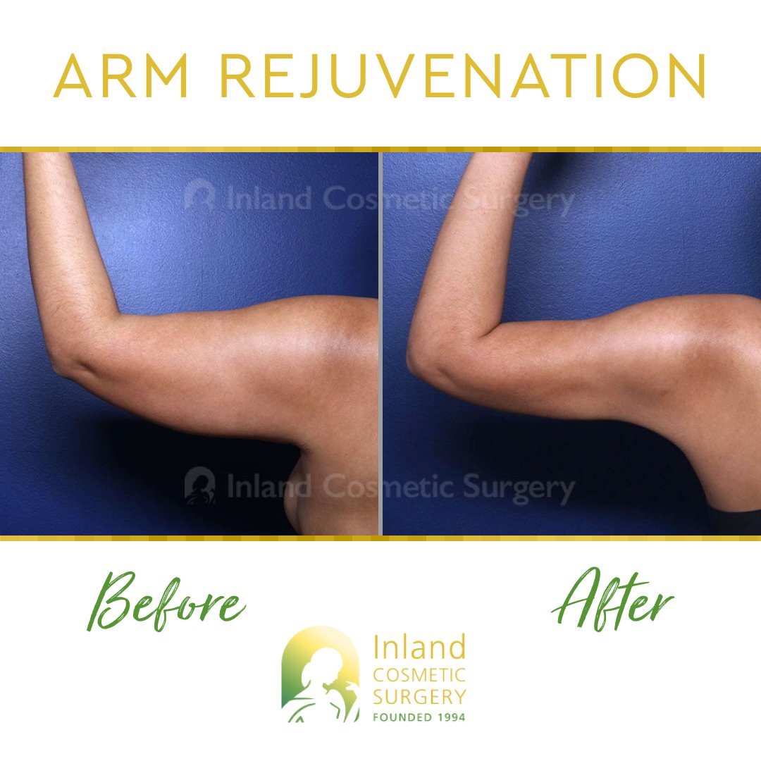 InlandCosmetic's tweet photo. Happy #TransformationTuesday! 🤩💪
This patient in her 30s is shown 1-year post-op from upper #ArmLiposuction with Renuvion. https://t.co/PHqF0hyr3u