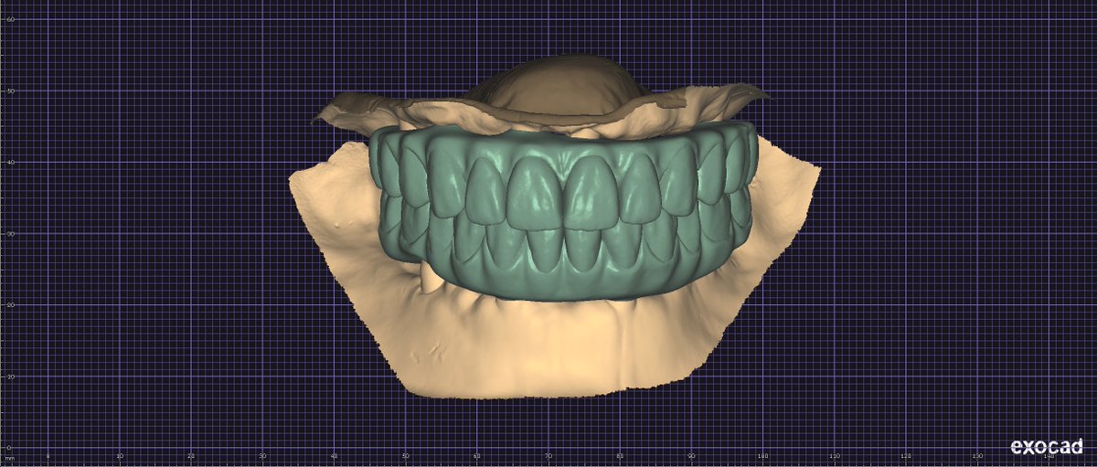 AdamRut9260's tweet photo. Check out this amazing All on X case designed in exocad by Rutherford Dental Lab! Our team of experts created a 3D model of the patient's face so you can see exactly how their new smile will look. #RutherfordDentalLab #AllOnX #Exocad #InstaRisa
https://t.co/pi1QKX49JS https://t.co/9KcPex9NQP