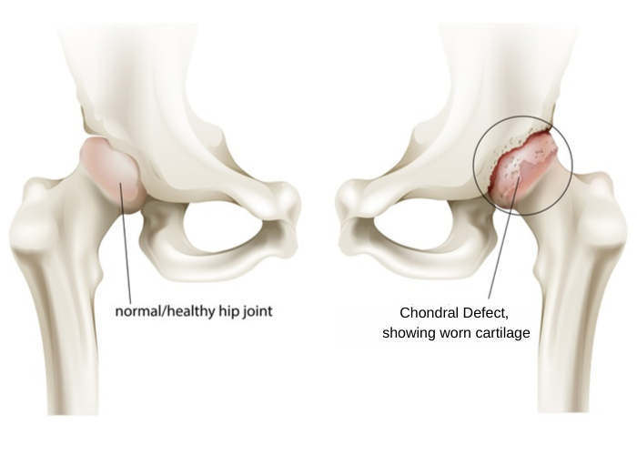 A #chondraldefect of the hip is a condition that occurs when there is #articularcartilage damage. The defect and/or damage to the articular cartilage can result in a number of conditions leading to various symptoms. medilink.us/wjq6  #hippain #sportsmedicine