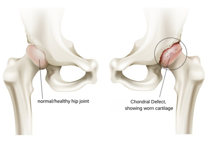 DrJeffPadalecki's tweet photo. A #chondraldefect of the hip is a condition that occurs when there is #articularcartilage damage. The defect and/or damage to the articular cartilage can result in a number of conditions leading to various symptoms. https://t.co/q2PLiXblty #hippain #sportsmedicine https://t.co/U1X4Uwag3K