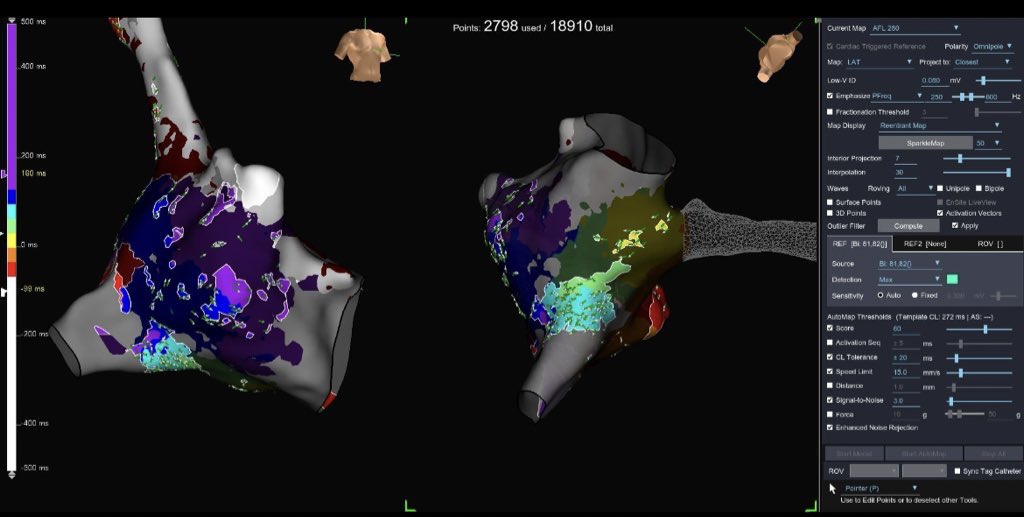 annacayford's tweet photo. Further, using a Peak Frequency #EmphasisMap made our ablation target clear. https://t.co/OD0iqtRlsc