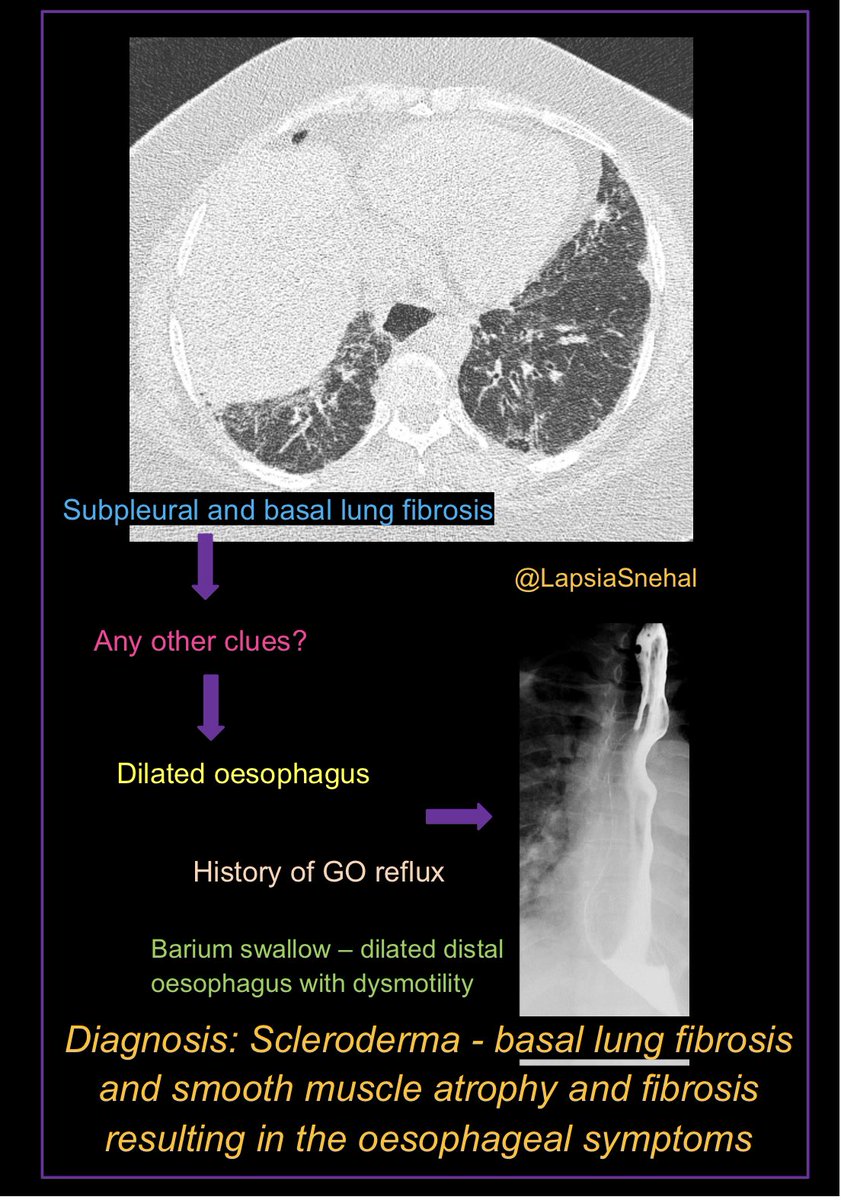 Sometimes the lung bases can provide a significant clue to abdominal disease. #FOAMrad #FOAMed #meded  #radres #futureradres #medstudenttwitter #gitwitter #anatomy #frcr #surgery #radiology #radtwitter #medtwitter #chestrad #msk #rheumatology