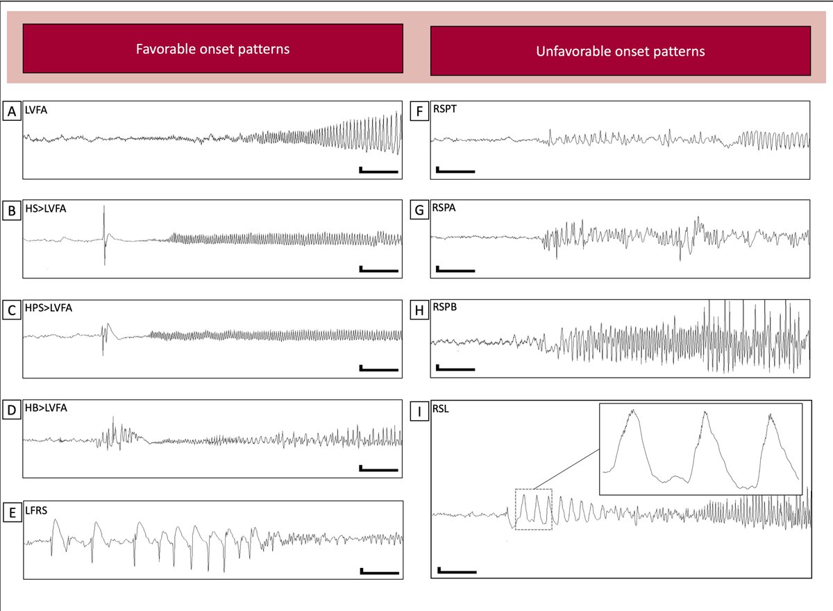 EpilepsiaJourn's tweet photo. Seizure onset patterns predict outcome after stereo-electroencephalography-guided laser amygdalohippocampotomy
https://t.co/vqUkYSDBnD
#epilepsy #ILAE #SEEG #SLAH #SOP #LITT #epilepsysurgery #temporallobeepilepsy #TLE @IlaeWeb @yesILAE @epilepsiajourn @WileyNeuro https://t.co/0NKfeLQA25