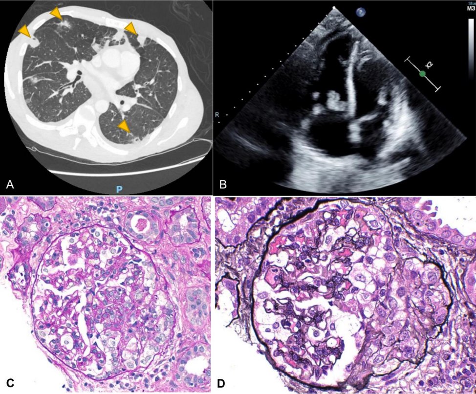 This Kidney Case Conference: Nephrology Quiz &amp; Questionnaire presents the case of a 44-year-old man with long history of opioid use disorder with worsening kidney function bit.ly/CJASN0154