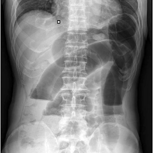 MoreXGrok's tweet photo. 67-year-old man

 👉nausea, abdominal pain, and distention for 1 day

 👉married and had 2 children

 👉denied any history of abdominal surgery 

Diagnosis? https://t.co/jGfhePuAyp