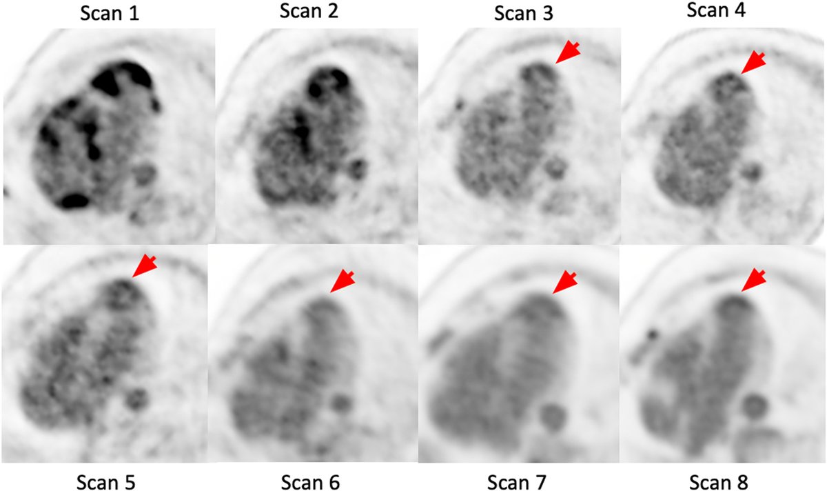 A new @PennCardiology #clinicalcase aimed to: 👉formulate diagnoses of persistent FDG uptake on serial PET imaging 👉understand the mechanistic rationale of alt. causes that may result in persistent FDG uptake spr.ly/6019OD6eU #Aneurysm #CVImaging @mkvidula @pacoebravo