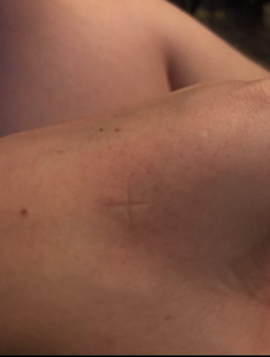 DrLongissimus's tweet photo. Med schools don't want your doctor to know this one simple trick to treat mosquitoe bites https://t.co/EiI7Fehm8p
