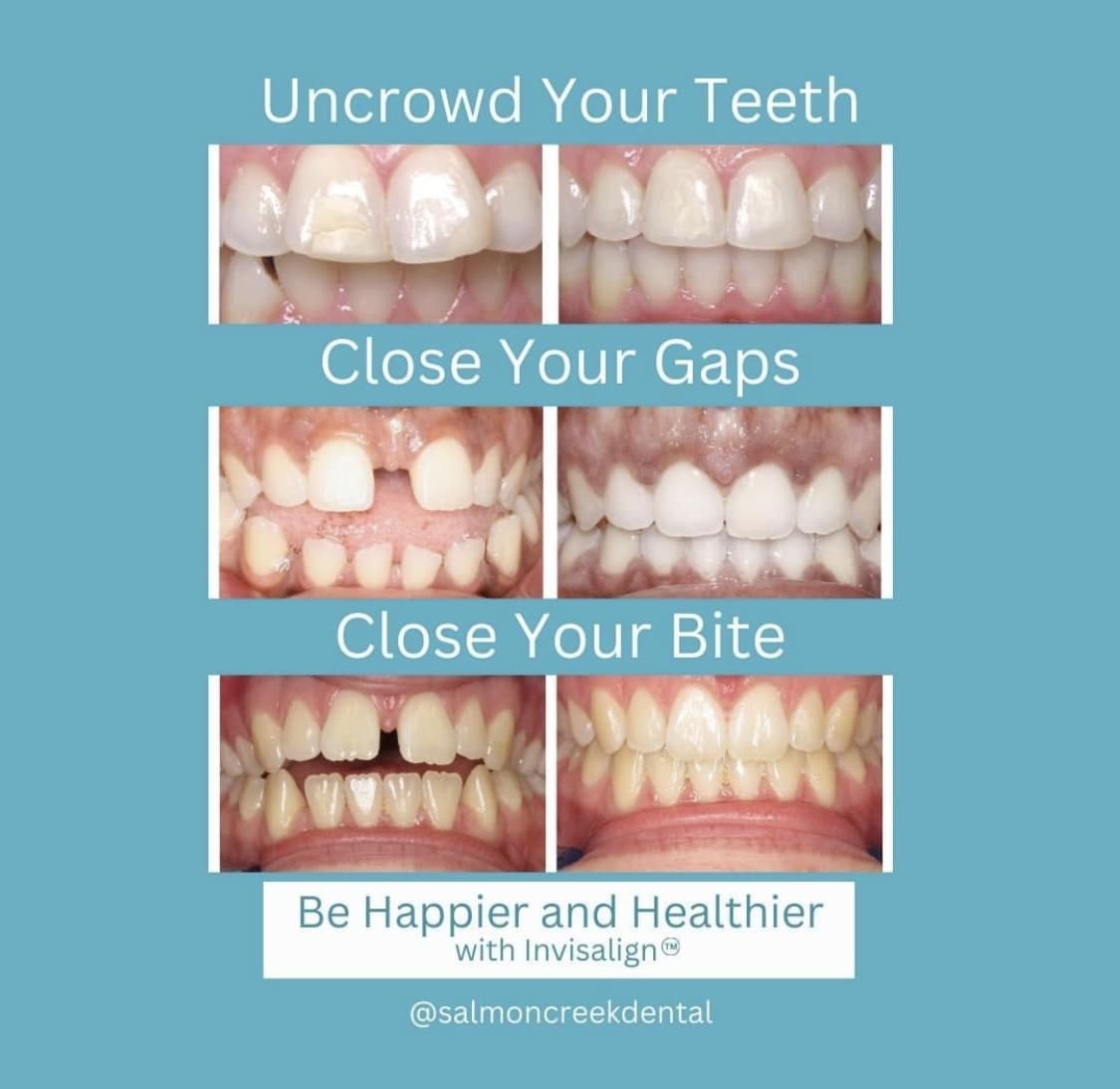 salmoncdental's tweet image. Invisalign is for everyone 🦷🤍

Call us to schedule your free 10 minute virtual consultation today 360-573-8230

#invisalignprovider #invisalignsmile #cosmeticdentistry #adultbraces
#invisalignjourney #invisalignvancouverwa #salmoncreekdentalcenter
#vancouverwa #pnwdentist