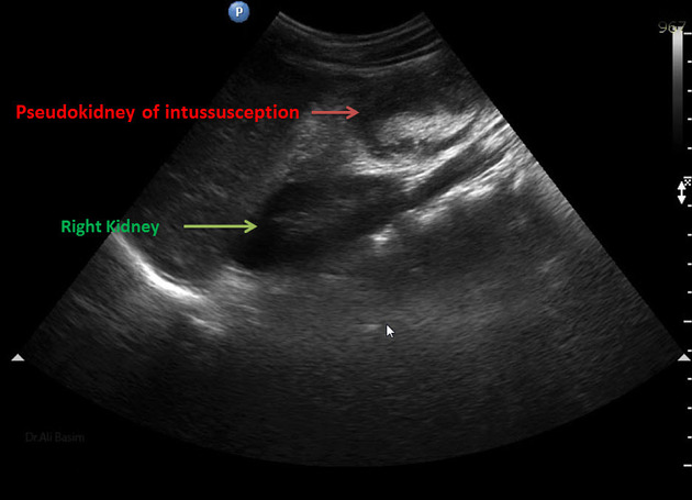 Thing I learned today: the 'pseudokidney sign' is an ultrasonographic finding in intestinal intussusception where the intussuscepted segment of bowel can mimic the appearance of the kidney. #tilt #ultrasound Credit: radiopaedia.org/articles/pseud…