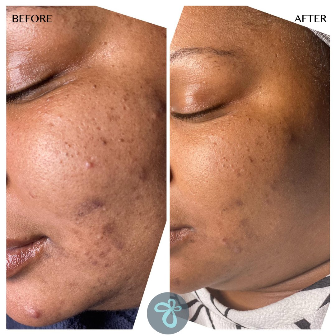 A CHEMICAL PEEL WITH NO DOWNTIME IS FINALLY HERE! ✨🙌💎🙌✨ BioRePeel (Blue) is a no-peel, no-pain, and no-downtime TCA peel. ✨✨✨✨✨ BioRePeel is also NOT PHOTOSENSITIVE which means this peel can be used year-round! 😍 The multi-action effects of the peel can be...