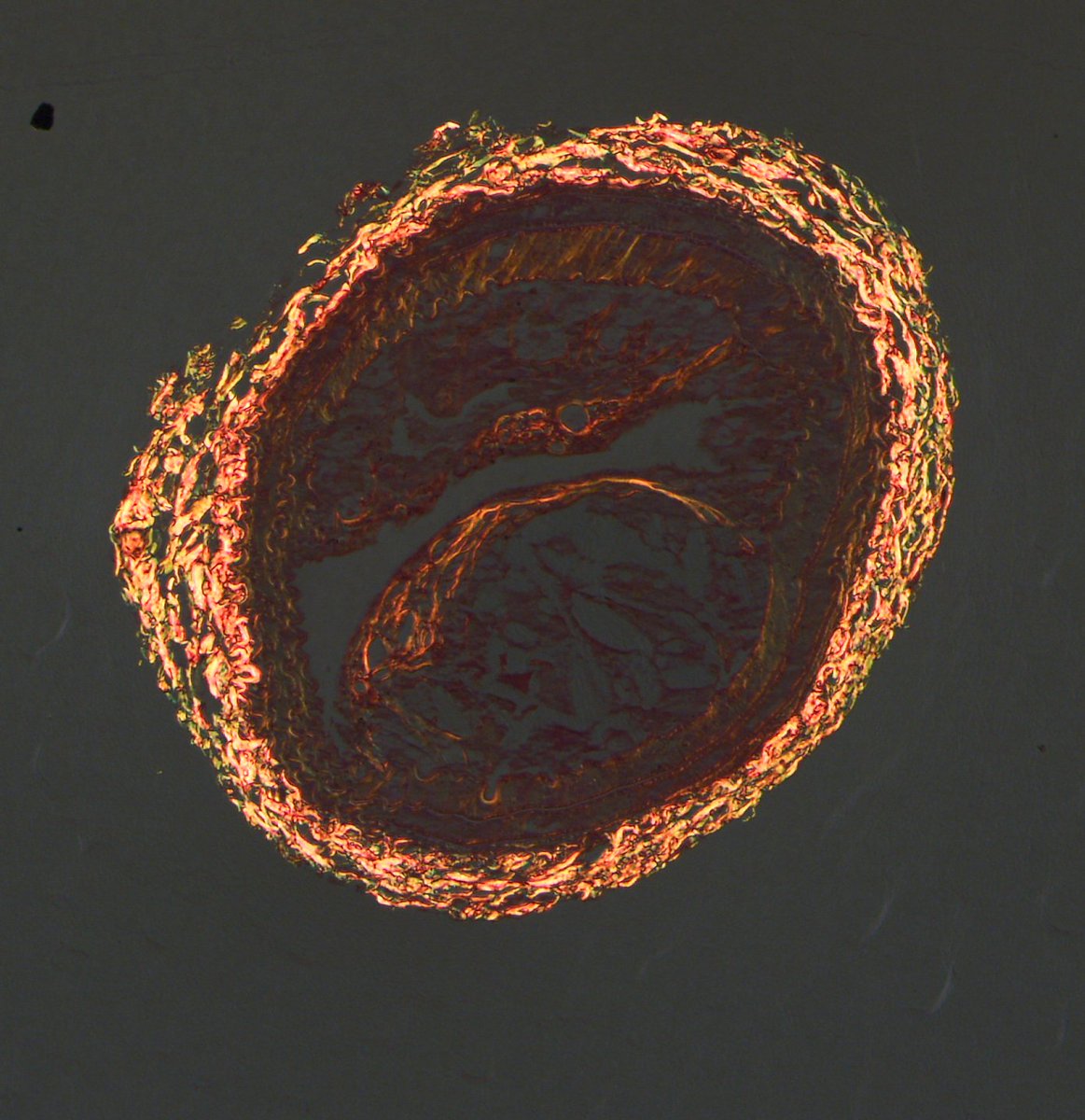 Circulation Research (@circres) on Twitter photo Chen & colleagues found the in the absence of #bilirubin a hyperlipidemic pro-atherogenic phenotype. Learn more about how mild #jaundice protects against #HeartDisease at ahajrnls.org/411ZyEg
<a href="/chenwy1988/">CHEN Weiyu</a> <a href="/DrSergeyTumanov/">Sergey Tumanov</a> <a href="/docnadel/">James Nadel</a> Chen & colleagues found the in the absence of #bilirubin a hyperlipidemic pro-atherogenic phenotype. Learn more about how mild #jaundice protects against #HeartDisease at ahajrnls.org/411ZyEg
<a href="/chenwy1988/">CHEN Weiyu</a> <a href="/DrSergeyTumanov/">Sergey Tumanov</a> <a href="/docnadel/">James Nadel</a>