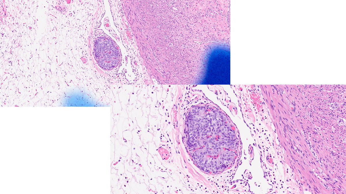 slusagar's tweet photo. #surgpath🧩time!

appendix showing acute appendicitis

and this focus:

🔬❓🤔 https://t.co/qSEMvgS72t