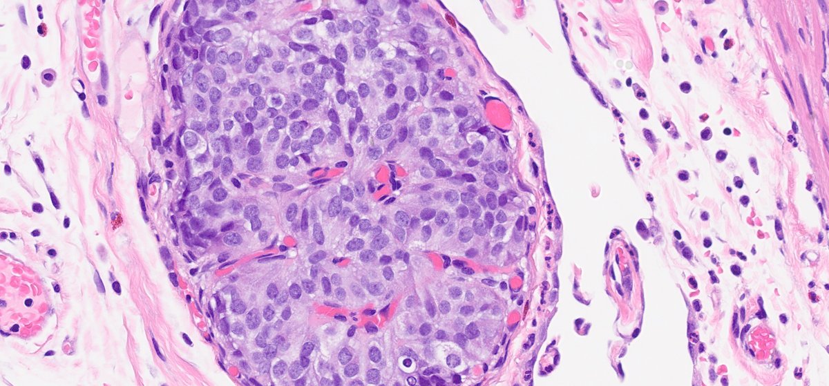 #surgpath🧩time!

appendix showing acute appendicitis

and this focus:

🔬❓🤔