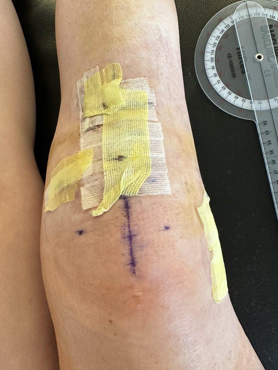 sofia412curtis's tweet photo. First post op pt appointment went great! @ACLclub @ACL_IWBBBTE https://t.co/qsEWdMcNCX