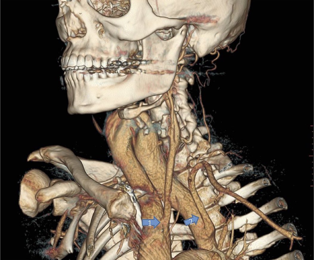 AvrahamCooperMD's tweet photo. Easily one of the coolest and craziest medical images I’ve seen - an aortic arch that extended way up into the person’s neck 🤯

#MedTwitter https://t.co/4OayAHslUW