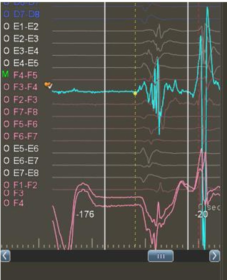 An easy way to map crista APCs? #Optrell's Local Conduction Vectors made it a breeze to distinguish between ectopic, sinus, and AT beats. #Carto #EPeeps @BiosenseWebster