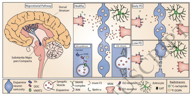 Dopamine release deficits in #Parkinsons there is actually dysfunction or dysregulation of axonal dopamine release before cell loss. Blows your mind right, think about it, and read this <a href="/Brain1878/">Brain</a> and it will make sense. academic.oup.com/brain/advance-…