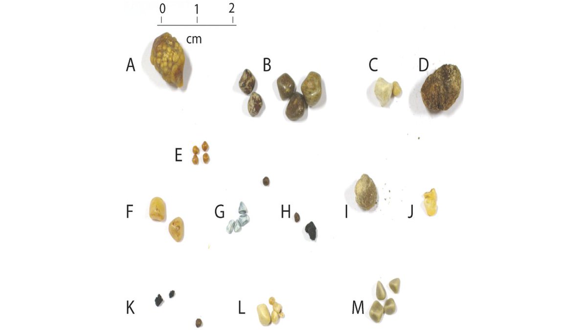 John on Twitter "8/ Let's Learn about Gallstones Gallstones are