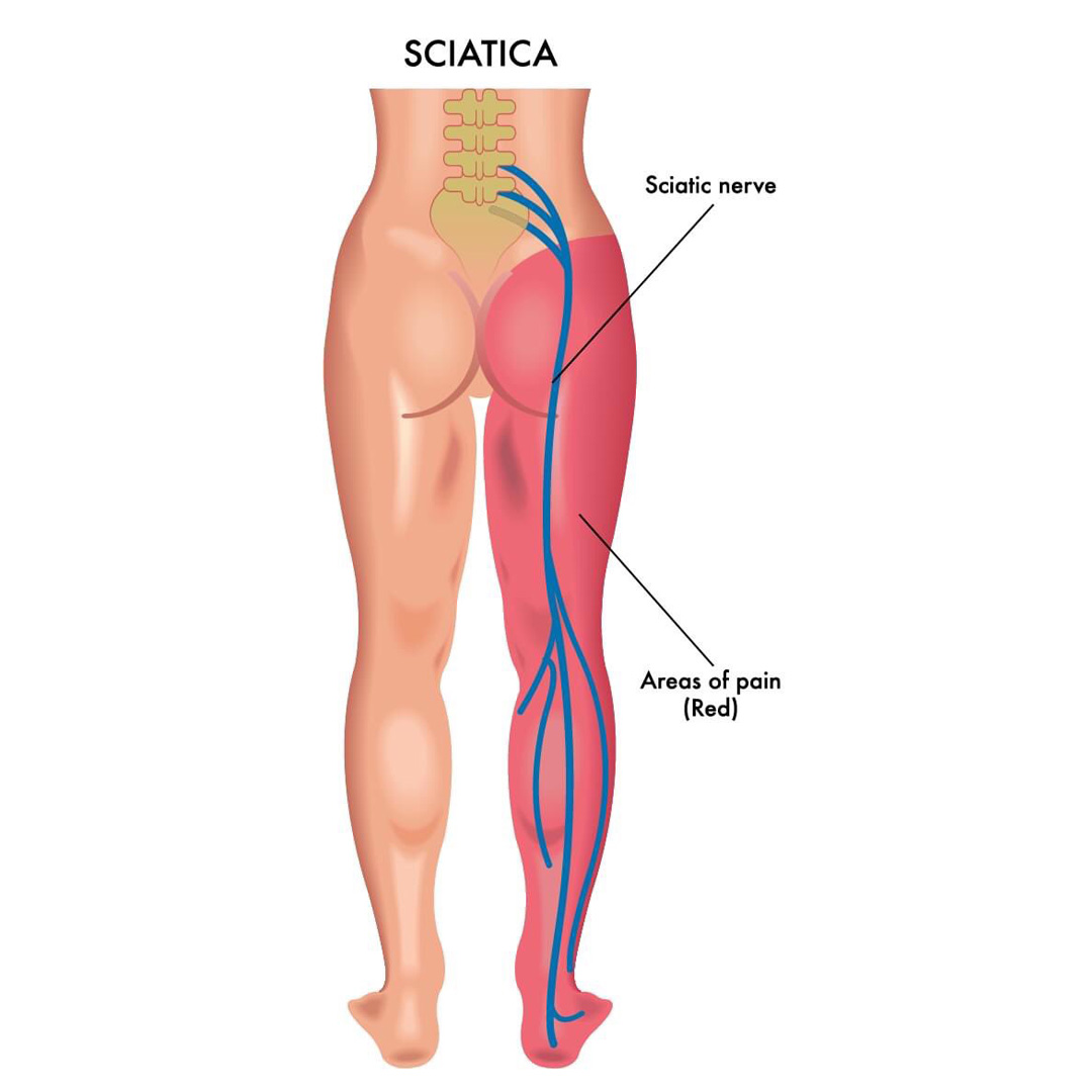 اي من الصورتين يمثل الالم الذي تشعر به ؟
شاركنا و سنقوم بمناقشة الالم و سببه و طرق علاجه   
ريتويت  🔄                      كومنت 💬