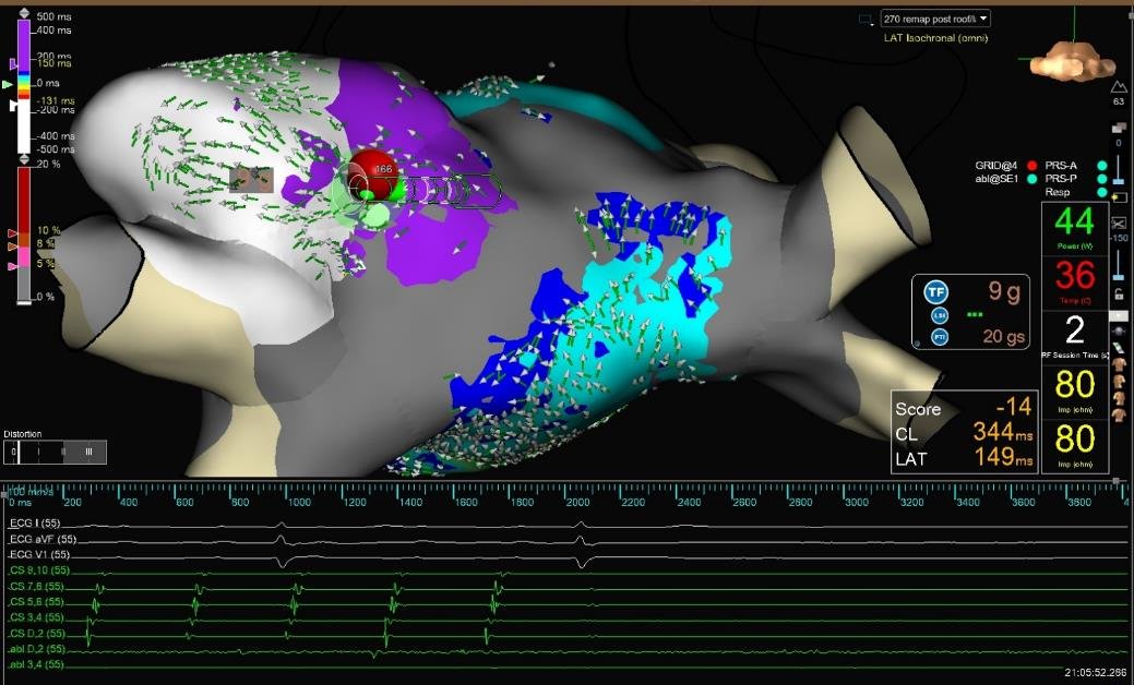 Danesh Modi (@daneshmodi) on Twitter photo <a href="/DrRoderickTung/">Roderick Tung</a> See this all the time! Redo for me (but felt like a four-do). Multiple epi connections. TCL slowed dramatically (+50 ms) with RF but then sped up again likely 2/2 conduction over new epi connection. Finally terminated @ red dot. <a href="/DrRoderickTung/">Roderick Tung</a> #EPeeps #Bachmann #SPBundle <a href="/DrRoderickTung/">Roderick Tung</a> See this all the time! Redo for me (but felt like a four-do). Multiple epi connections. TCL slowed dramatically (+50 ms) with RF but then sped up again likely 2/2 conduction over new epi connection. Finally terminated @ red dot. <a href="/DrRoderickTung/">Roderick Tung</a> #EPeeps #Bachmann #SPBundle