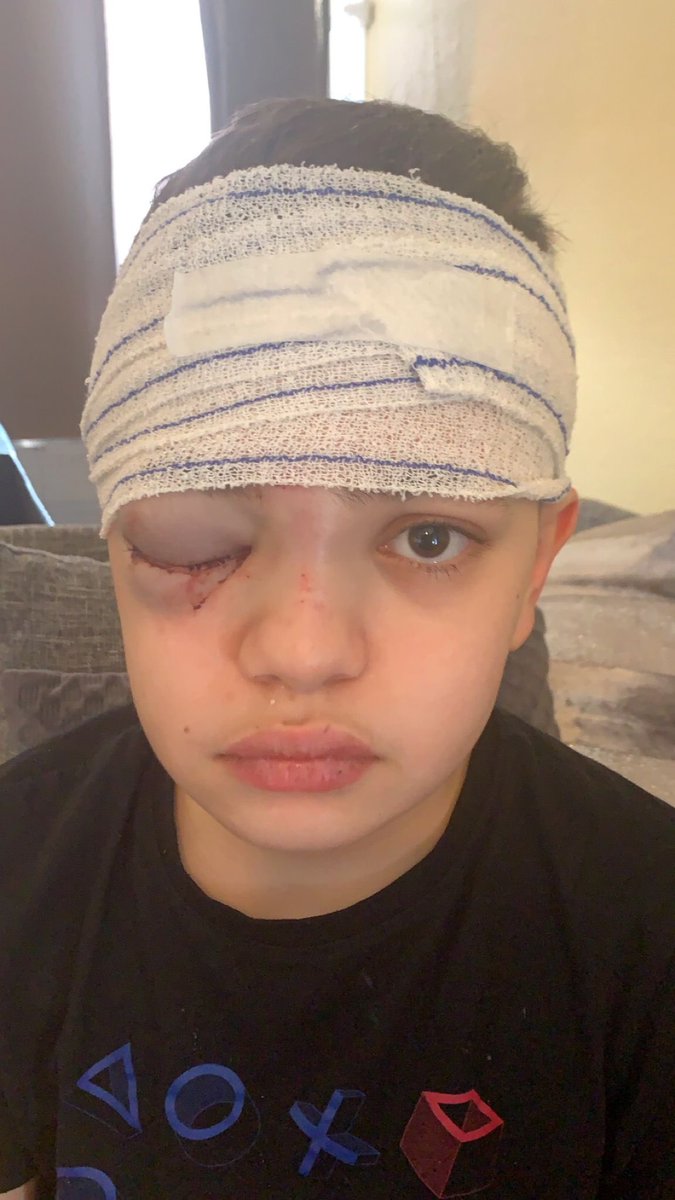 GossipRoomOff's tweet photo. 🚨 Farès est un jeune collégien harcelé qui a été poussé dans les escaliers de son établissement à Carcassonne. Sa mère, Sarah, affirme que l'établissement scolaire et les forces de l'ordre ne croient pas la version de son fils.

C'est le mercredi 22 mars que le collégien est poussé dans les escaliers. Il dévale au moins 7 marches avant de s’écraser sur le sol, en sang. Bilan : une paupière ouverte qui a provoqué un hématome encore visible aujourd’hui et le nez cassé.

Les professeurs du collège où est scolarisé le petit Farès rapportent que Farès est un "menteur", qu'il s'est "pris les pieds dans ses lacets" et que sa mère est "à la recherche de buzz". Des parents d'élèves ont ajouté qu'il n'y avait pas aucun harcèlement scolaire dans l'établissement. 🏫📚 (via Midi-Libre)