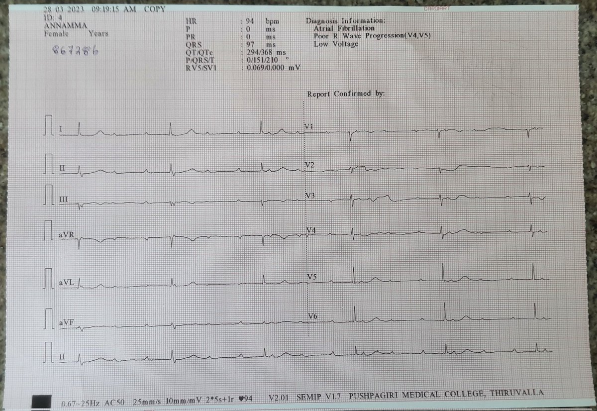 mitt_zone04's tweet photo. 80yr old lady K/c/o DM-T2, HTN c/o palpitations and giddiness for past 2 days. BP- 130/70; This was her initial ECG. https://t.co/zRpRMLUwWg