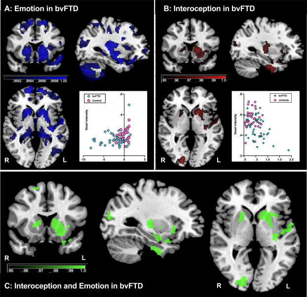 AgustinMIbanez's tweet photo. Our work on emotion mechanisms 🧠💡: In #bvFTD, emotion deficits may be due to challenges in perceiving interoceptive cues, like one's heartbeat 💓. But cognitive impairments seem to drive such deficits in #Alzheimers & #ParkinsonsDisease. Congrats @_JLHazelton  and team for this nice work! 👉 https://t.co/hLuiZRtNqz @CORTEXjournal @atlanticfellows @GBHI_Fellows @Olivier_Piguet