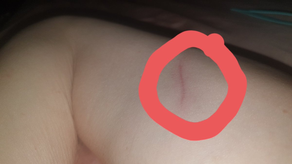 Healed nice! Still weak though and half numb :-(