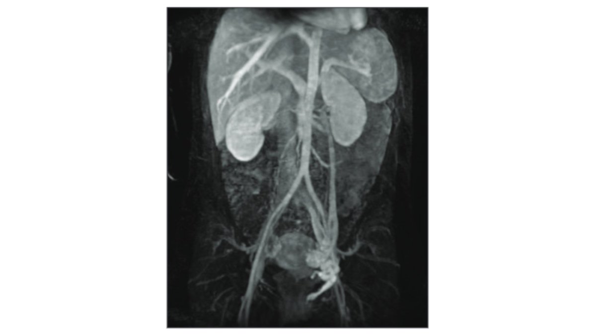 New <a href="/AJR_Radiology/">AJR</a> Accepted Manuscript:

"Diagnosis and Management of Pelvic Venous Disorders: AJR Expert Panel Narrative Review"

By Dr Knuttinen &amp; team 

ajronline.org/doi/abs/10.221…