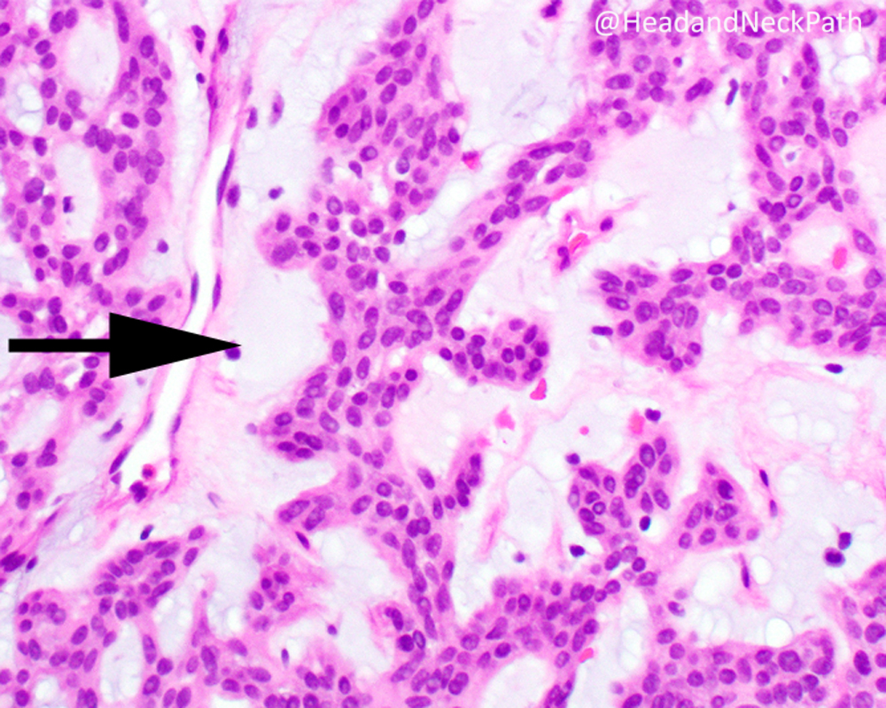 HeadandNeckPath's tweet photo. Top Ten Differentials to Mull Over for Head and Neck Myoepithelial Neoplasms
By Lester D. R. Thompson &amp; Bin Xu
https://t.co/dMAY7Lz9Rg
#HeadNeckPathol #HNPJ #HeadandNeckPath #Pathology #ENTPath #PathologyTweet https://t.co/1ZaF4vrY4C