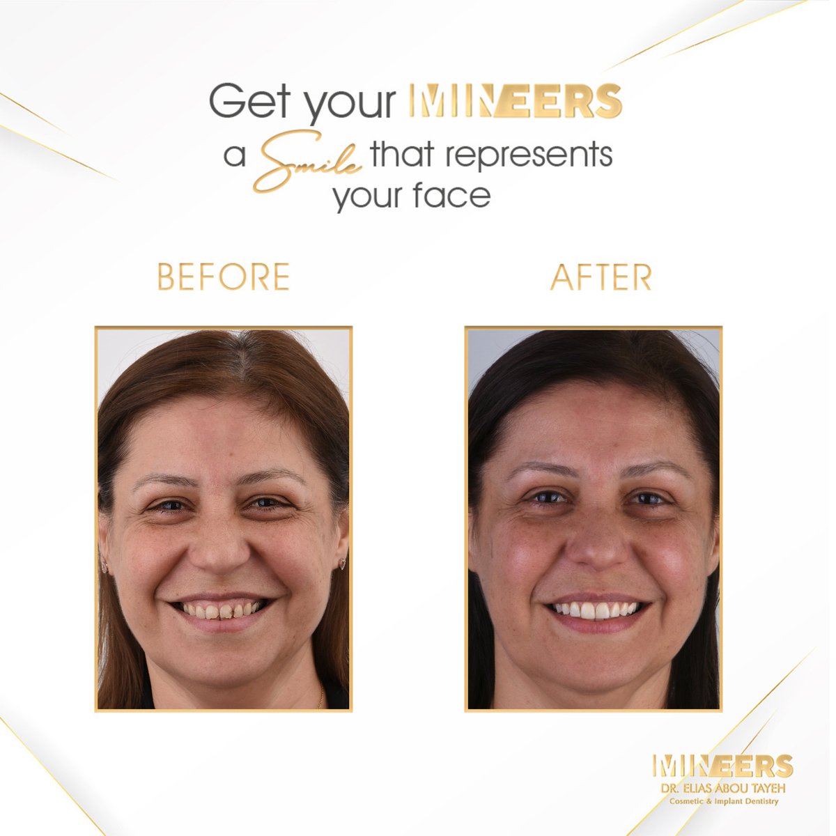 From Decay to Dazzling: A Stunning Veneer Transformation

Book Your Appointment Now:

🇱🇧 : +961 3 757 127
#Mineers #CompositeVeneers #DentalTransformation #PerfectSmile #CosmeticDentistry #TeethGoals #ConfidentSmile #DentalVeneers #Dentist #Lebanon #dentistnearme #bestdentist
